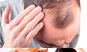 Hair Loss Control <br/><sup>(Mezoterapie Scalp, Păr, Barbă)</sup>