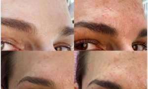 Chemical Peel Melanină <br/><sup>(Set Peeling Chimic Profesional)</sup>