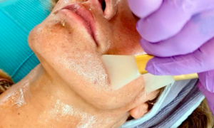 Chemical Peel Acnee <br/><sup>( Set Peeling Chimic Contra Acneei)</sup>